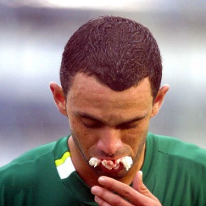 Magrão joga com dente quebrado em jogo contra o São Caetano, em 2004, ao levar cotovelada de Zé Carlos. Foto: UOL